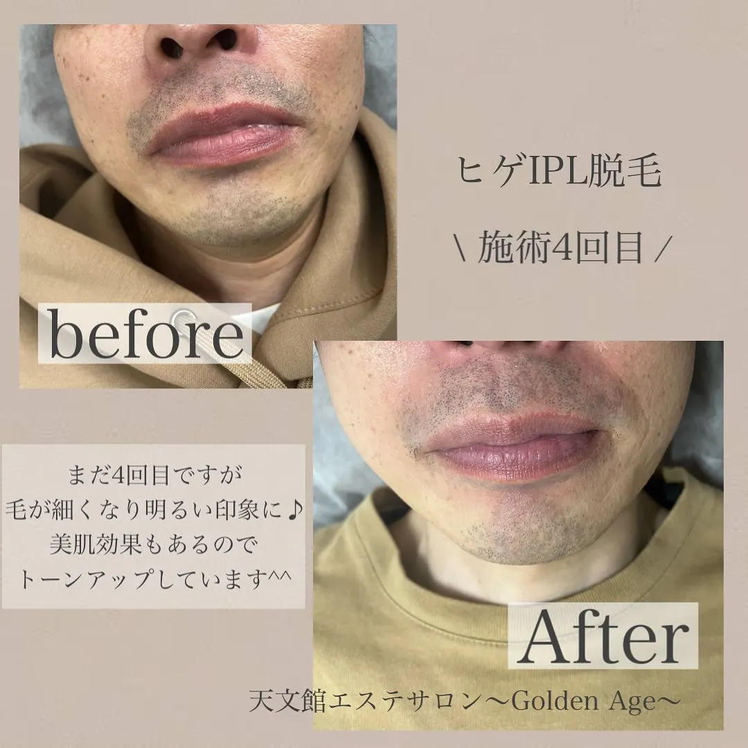 ﹨ before ✿ After ∕