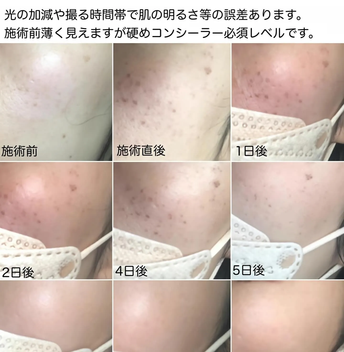 【お肌のトラブル改善】光フェイシャル✨✨✨