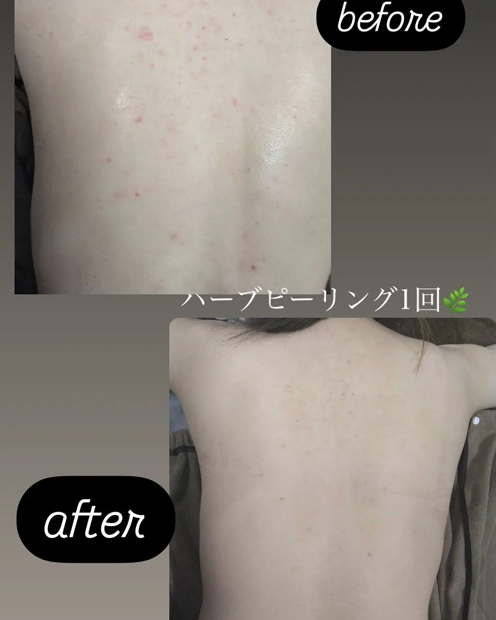 ﹨ 背中ハーブピーリング🌿.∘ ∕