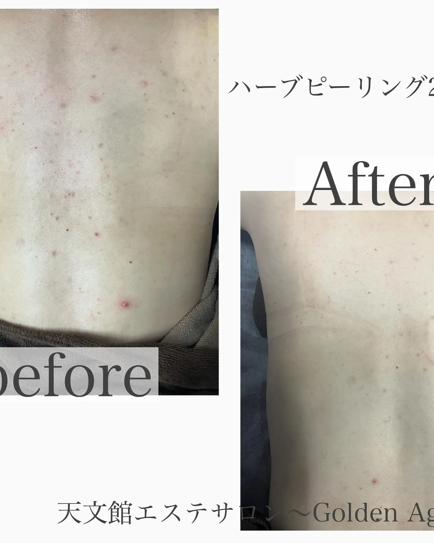 ﹨ 背中ハーブピーリング🌿.∘ ∕