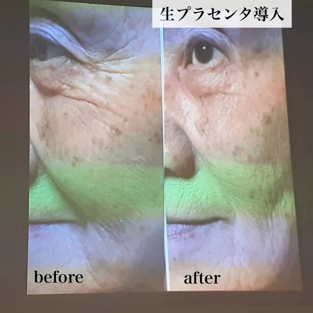 ﹨ 生プラセンタのすごい効果✨️🫧 ∕