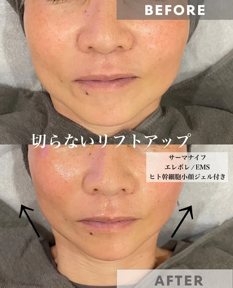 ﹨ 女性人気NO.1 👑 小顔フェイシャル ∕