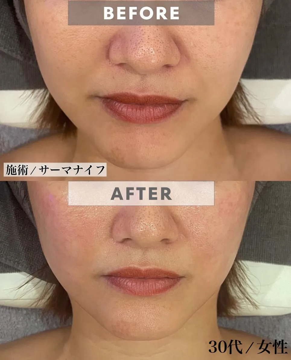 ﹨ 女性人気NO.1 👑 小顔フェイシャル ∕