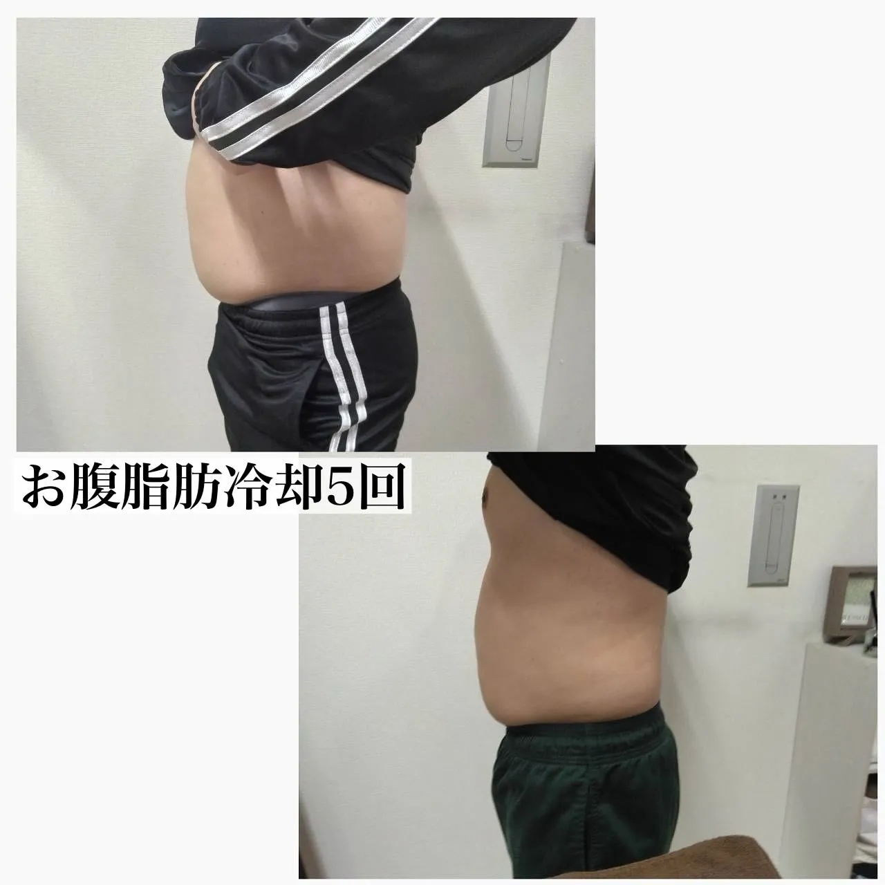 ﹨ 脂肪冷却🧊before after 📷 ́͏̖- ∕