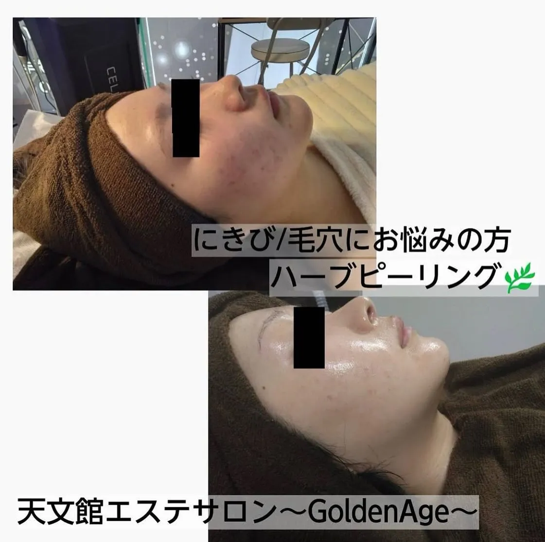 ハーブピーリング🌿ブライダルエステや毛穴,ニキビ跡改善💆♀...