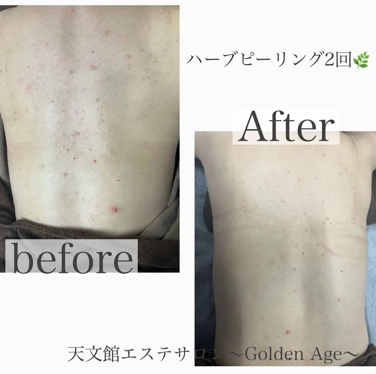 ハーブピーリング🌿ブライダルエステや毛穴,ニキビ跡改善💆♀...