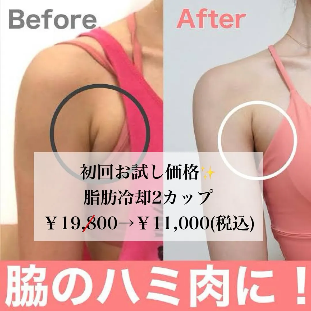 ﹨ 脇下脂肪冷却 脂肪冷却鹿児島市 二の腕痩せ 脂肪冷却キャ...