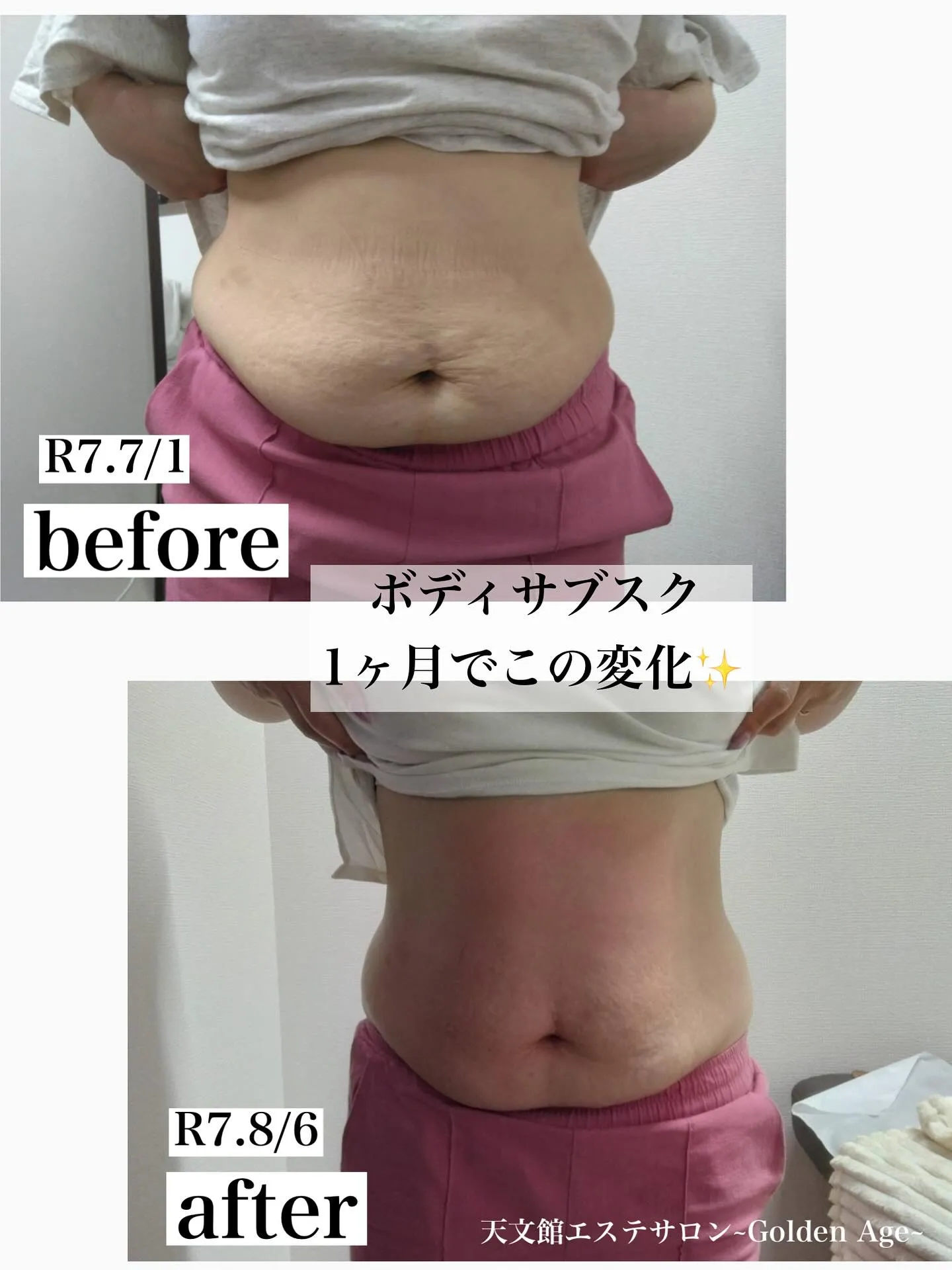 ﹨サブスクで短期集中ケア✨️ ∕ 脂肪冷却鹿児島 エステ通い...