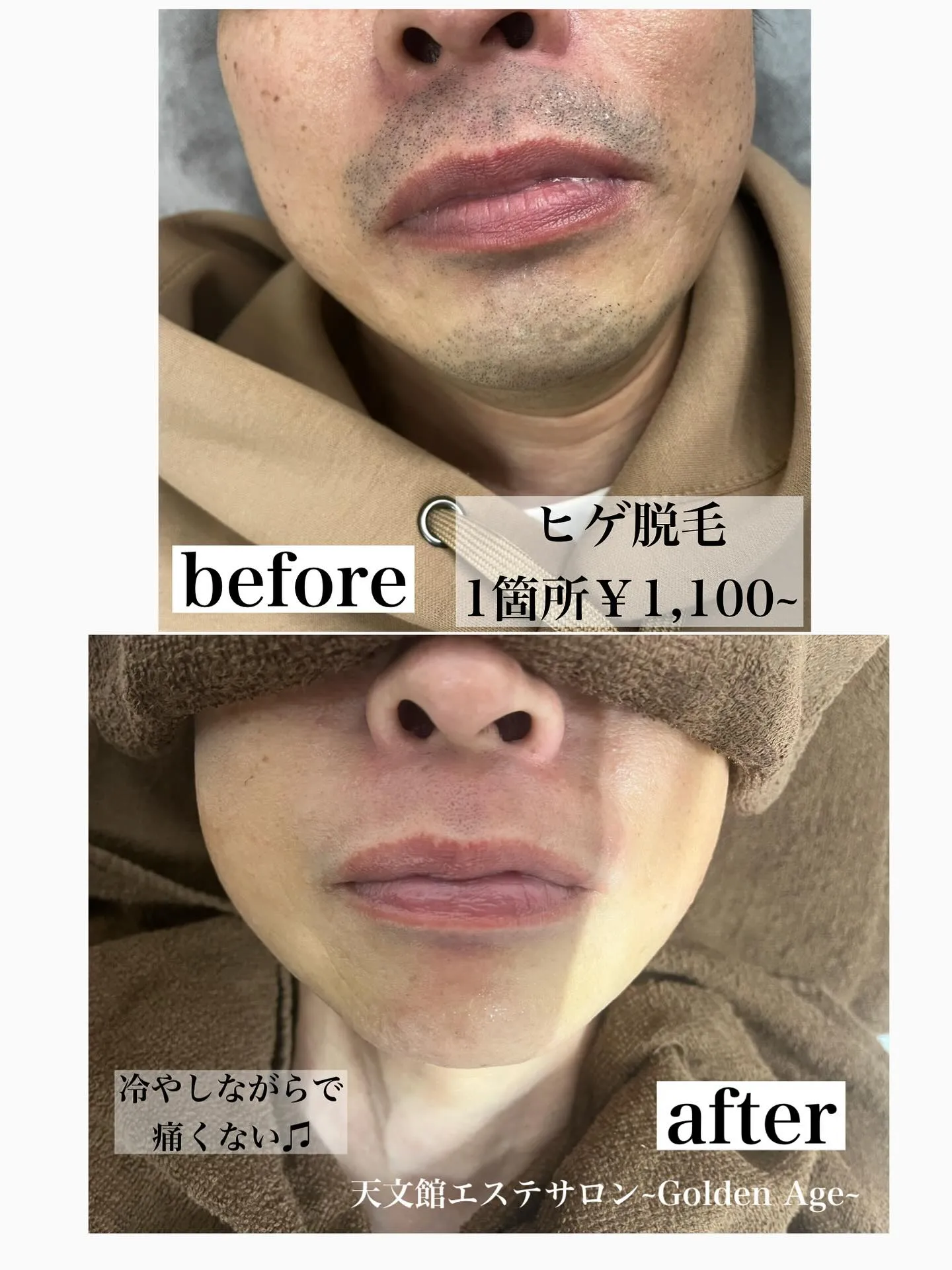 ﹨ ヒゲ脱毛1箇所￥1,100~✨️ ∕  メンズ脱毛鹿児島...