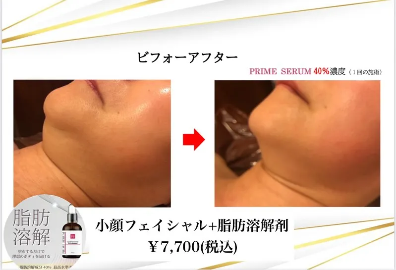 ﹨ あご下肉スッキリ✨️1day小顔 リフトアップ ∕