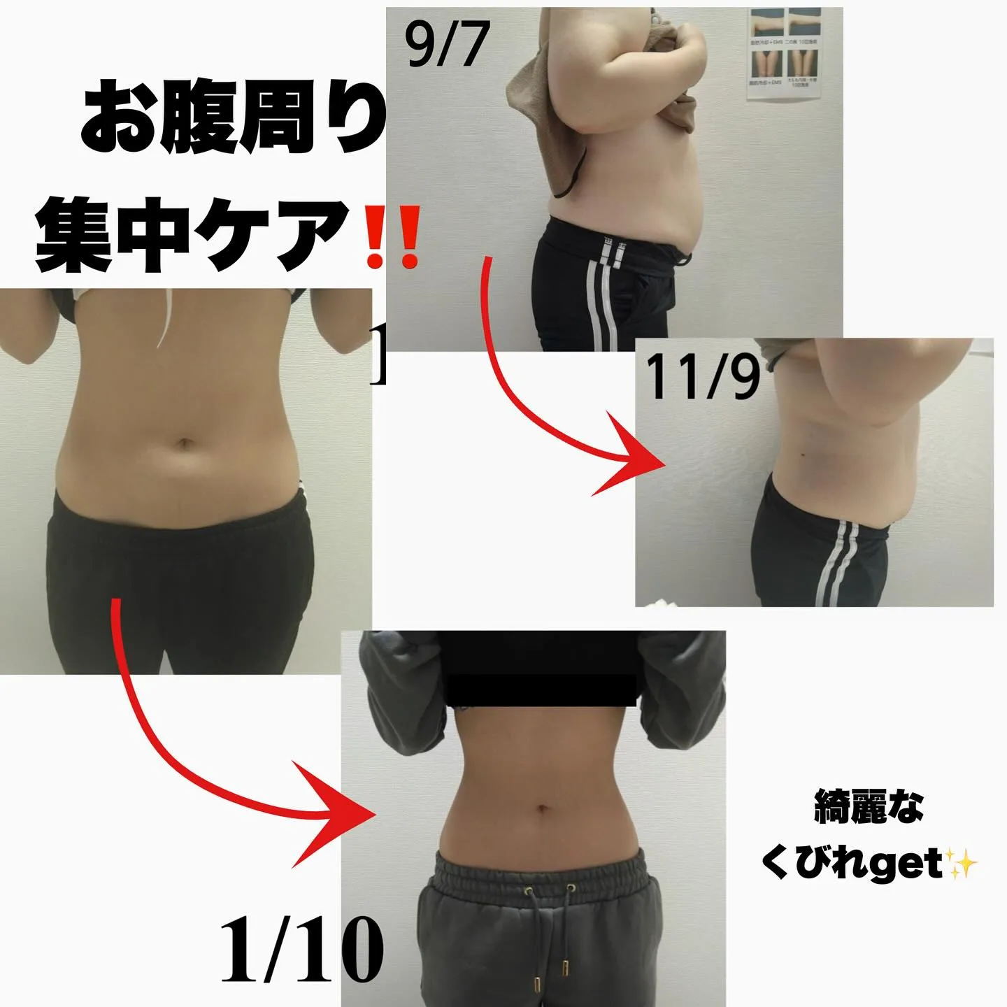 小顔！脂肪冷却！通い放題♪ エステサブスク💪🏻❤️‍🔥⋆͛