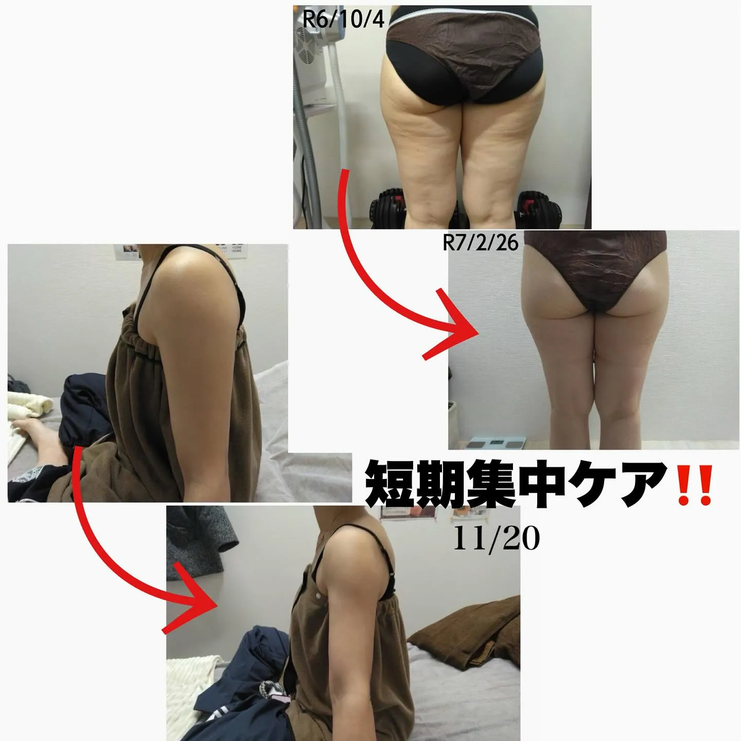 小顔！脂肪冷却！通い放題♪ エステサブスク💪🏻❤️‍🔥⋆͛