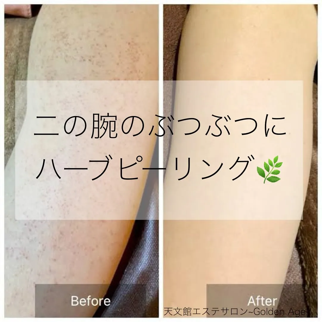 ﹨ 二の腕のぶつぶつに🌿‬ハーブピーリング🌿 ∕