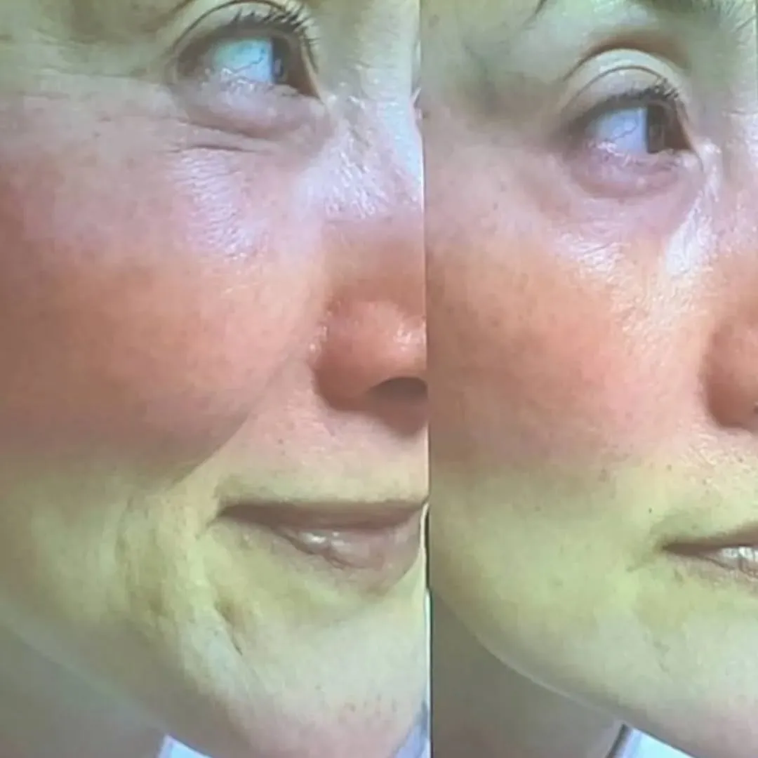 ほうれい線撃退の生プラセンタ導入の極上フェイシャル✨