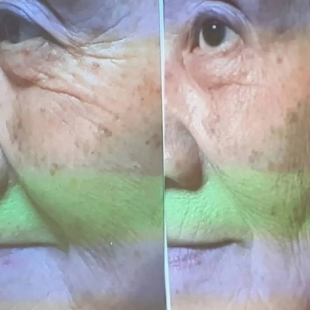 ほうれい線撃退の生プラセンタ導入の極上フェイシャル✨