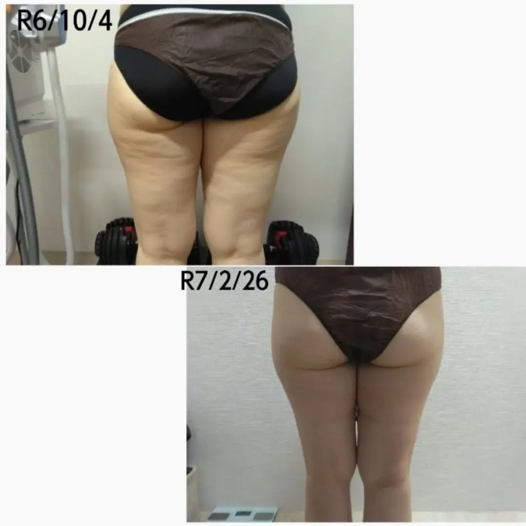 脂肪冷却＋脂肪溶解剤=最短でリバウンドしない痩身✨