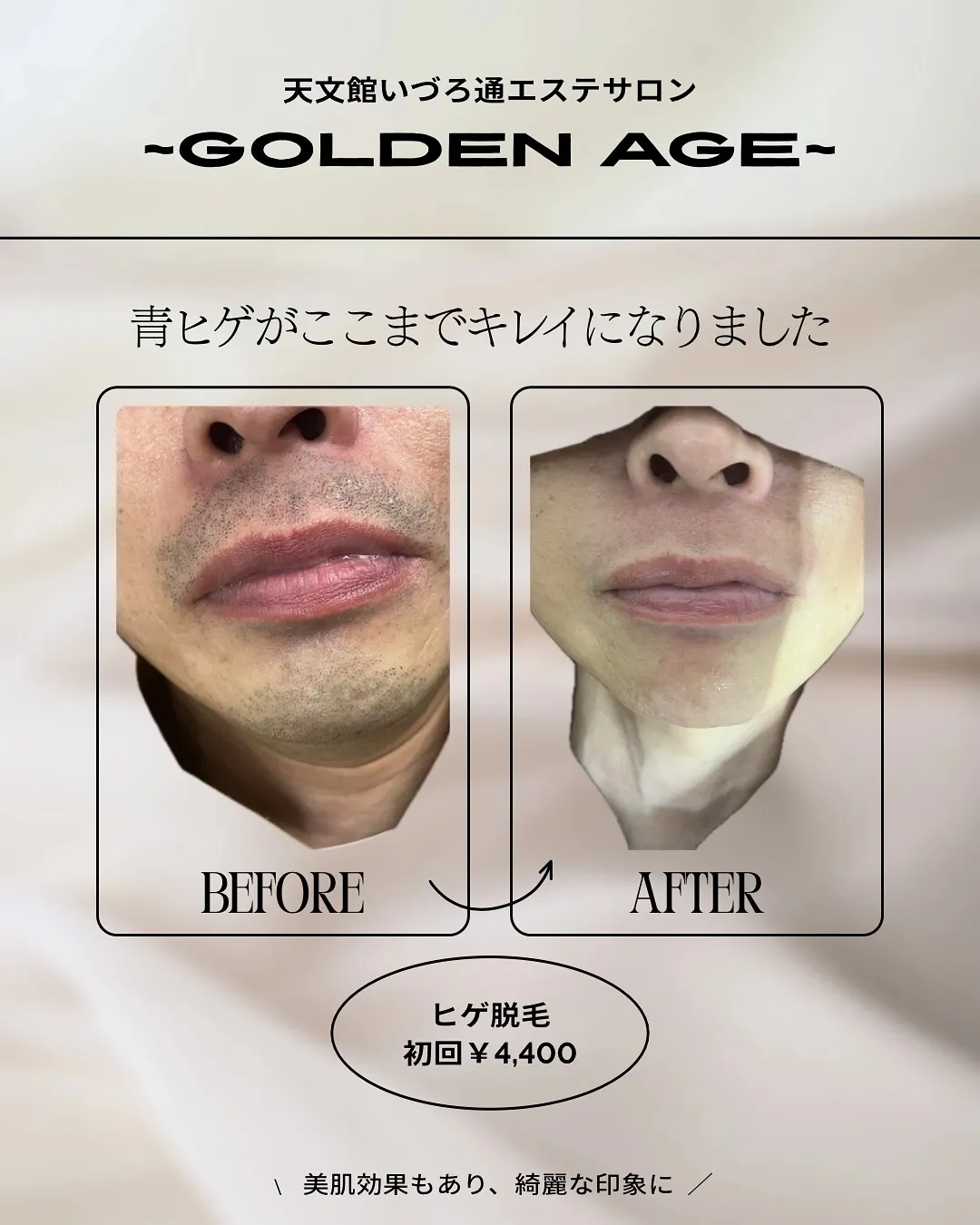 【脱】青ひげ！メンズ ヒゲ脱毛で毎日の髭剃りから卒業🎓✨️