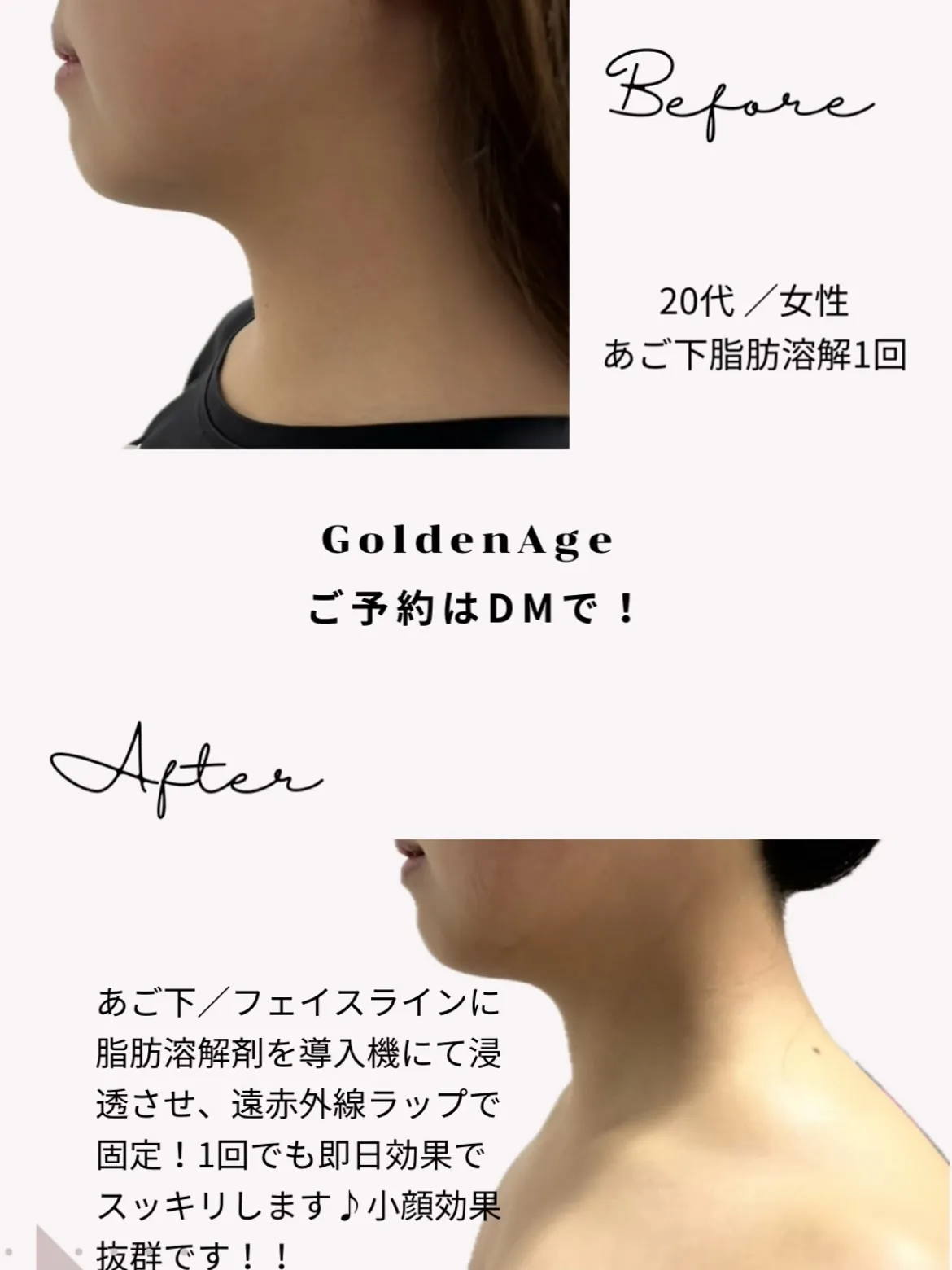 1日で小顔が叶う✨️脂肪溶解剤であご下肉撃退‼️