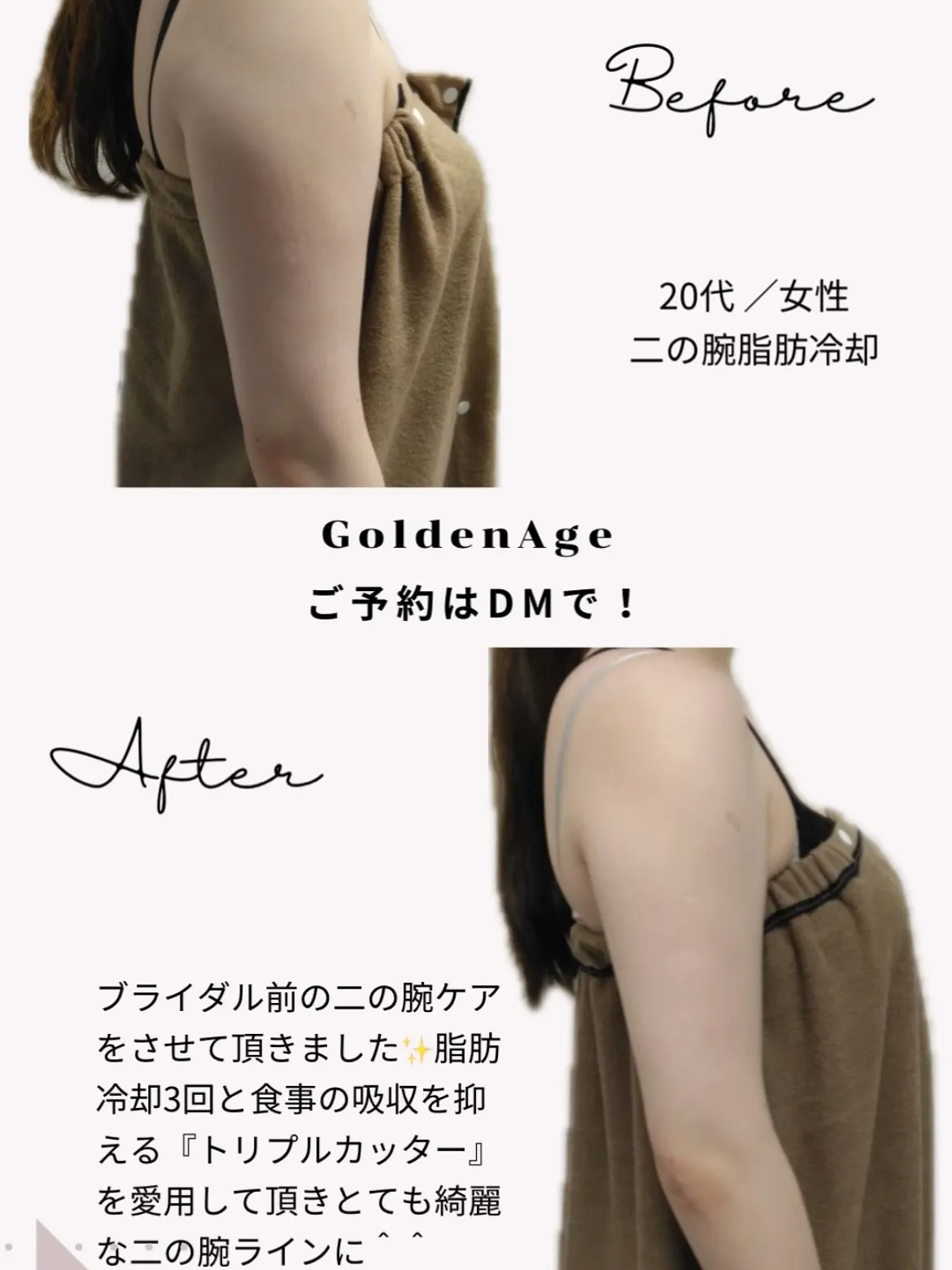 ブライダル前の二の腕痩せ🔥💪全力サポートします✊🏻 ̖́-
