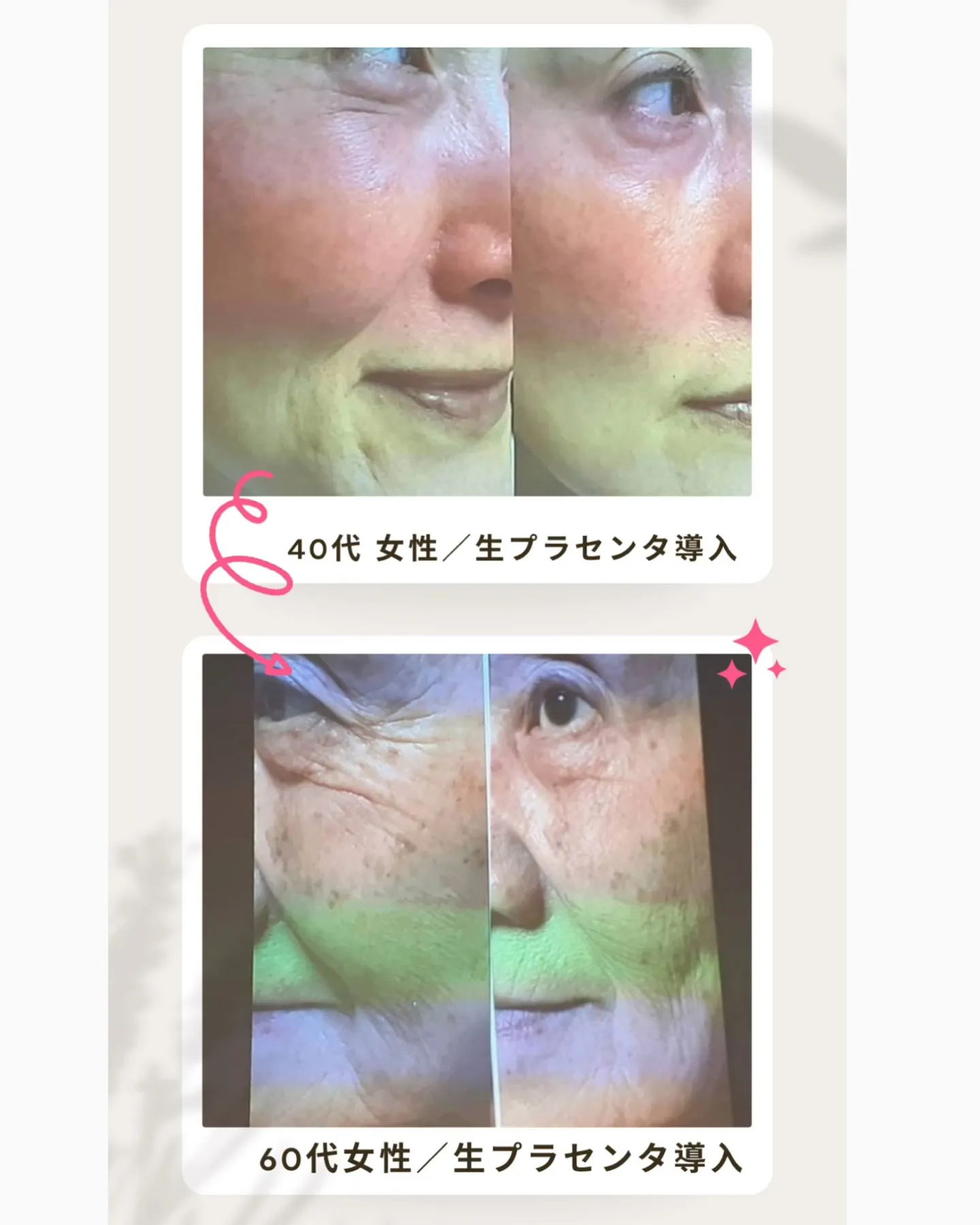 冬おすすめフェイシャル⛄️乾燥肌 シワ改善 ハリ艶蘇る 極上...