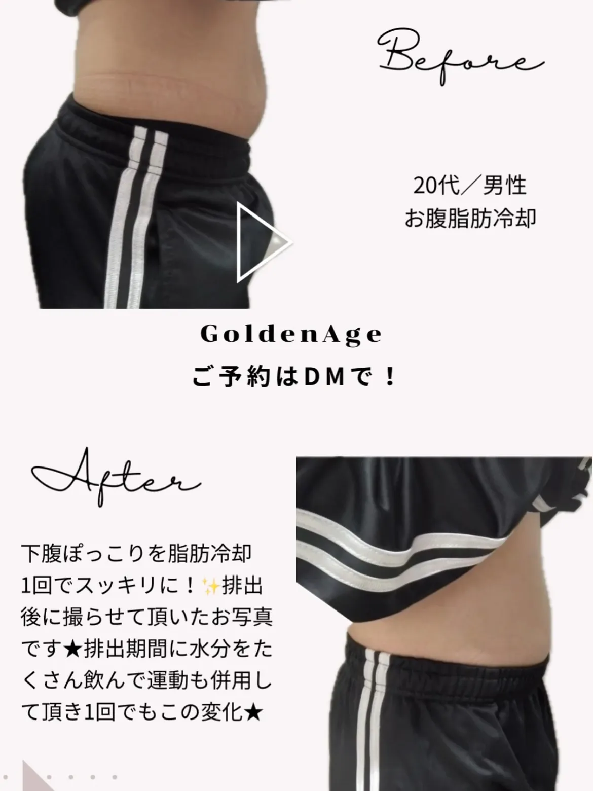 お腹の脂肪撃退👊💥鹿児島で痩身をお探しなら脂肪冷却‼️