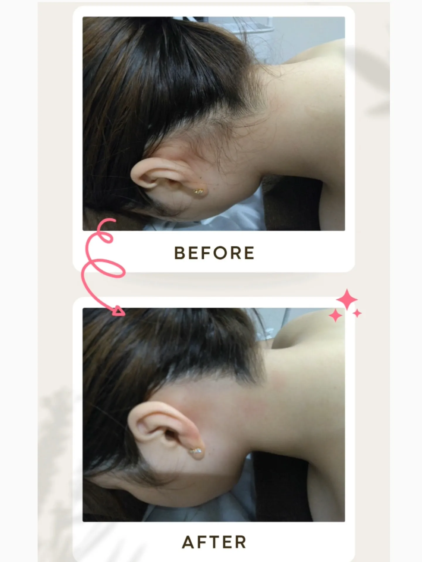 後ろ姿が一気に垢抜け❣️成人式前におすすめ【うなじ脱毛】✨️