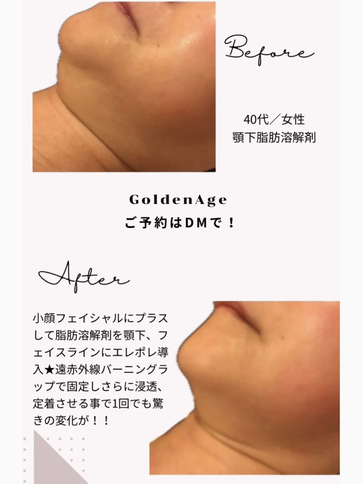 1日で小顔効果絶大✨️ 脂肪溶解剤で顎下肉がスッキリ🤍ꔛ‬