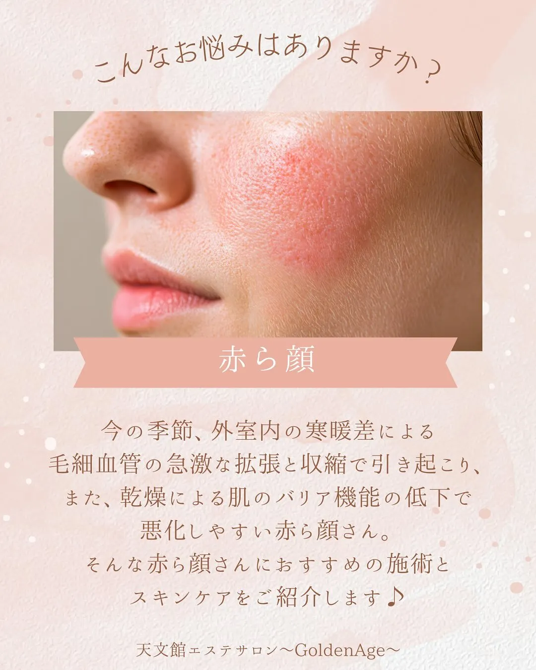 フォトフェイシャルで赤ら顔を改善🙌🥰