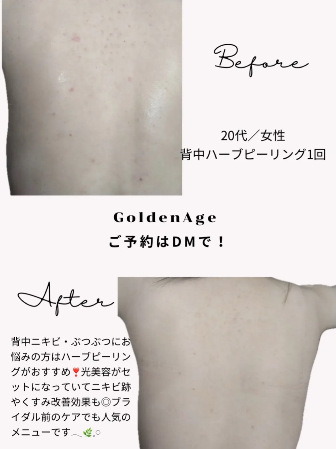 背中にきび 背中ぶつぶつ 背中ハーブピーリング𓂃🌿𓈒𓏸