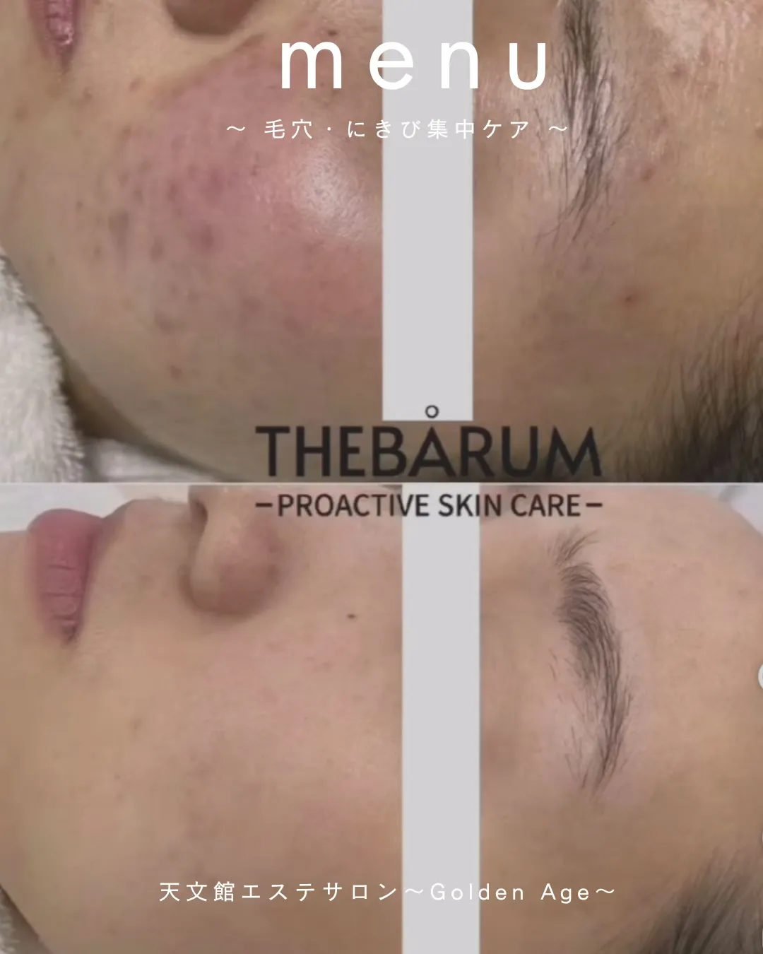 毛穴・⁡にきび集中ケア 韓国発フェイシャル