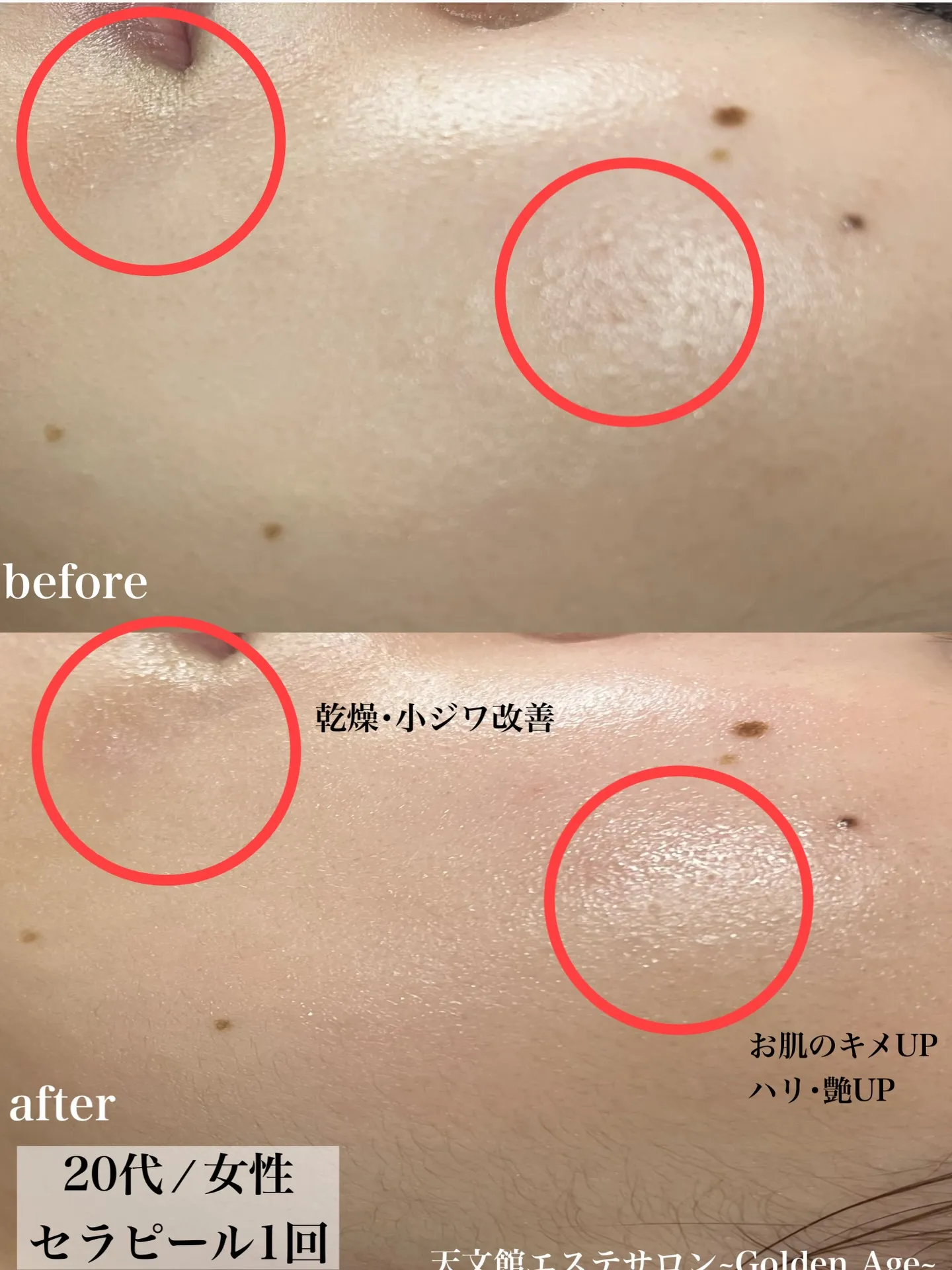 ララピールの進化版『セラピール』天文館初✨️導入‼️