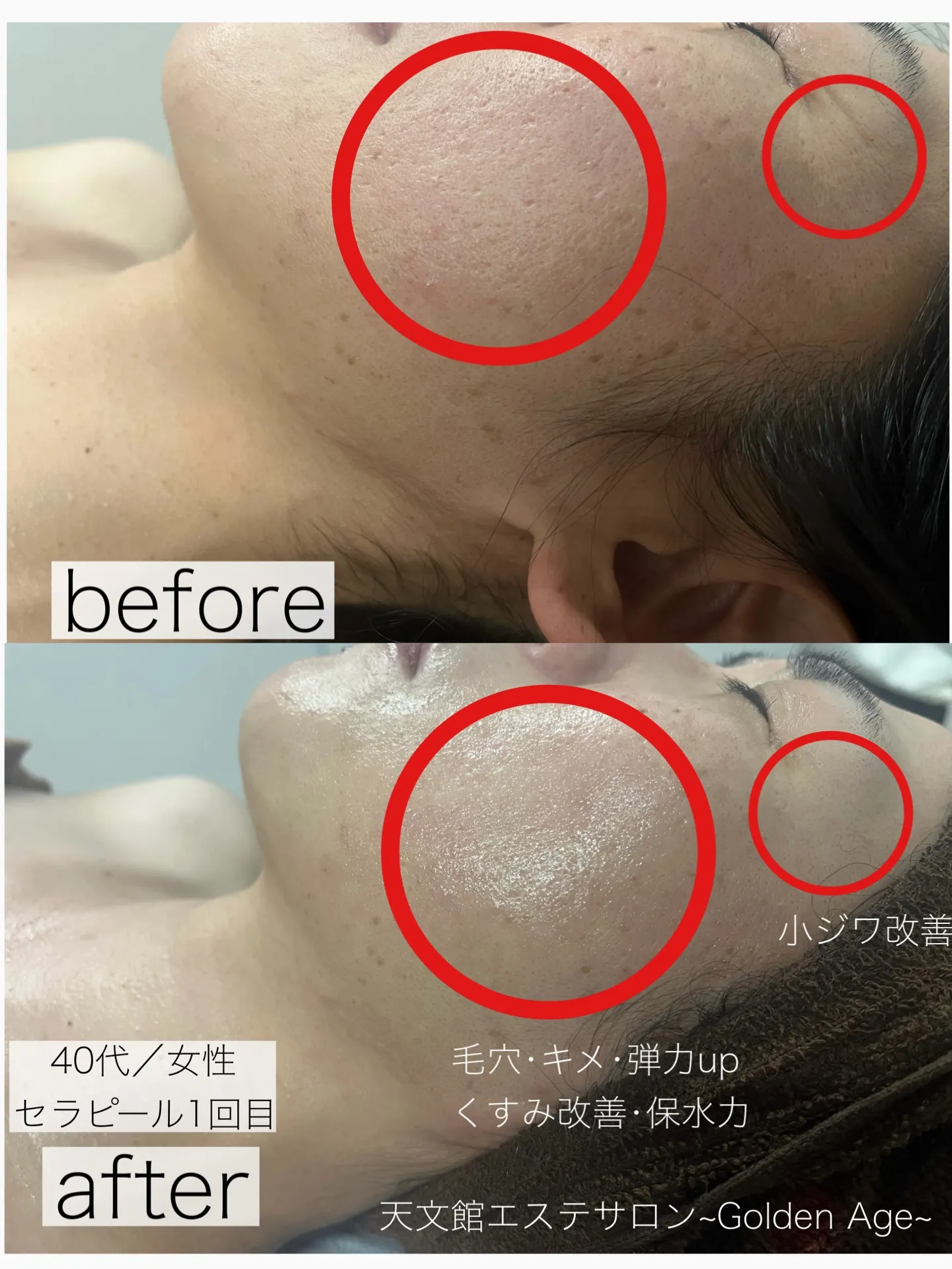 ﹨ 毛穴･にきび肌･韓国肌質改善No.1👑セラピール ∕