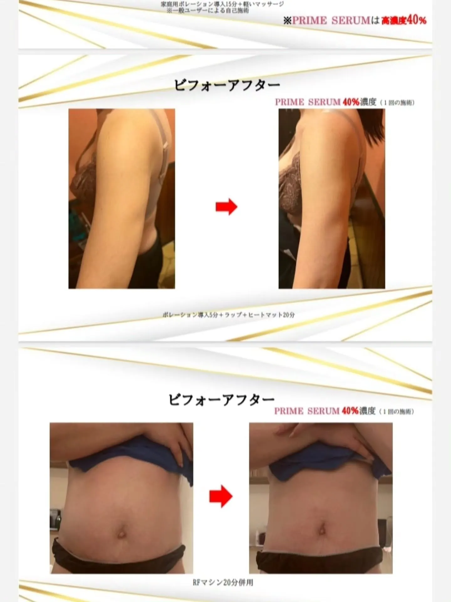 鹿児島市天文館で脂肪溶解剤と脂肪冷却を