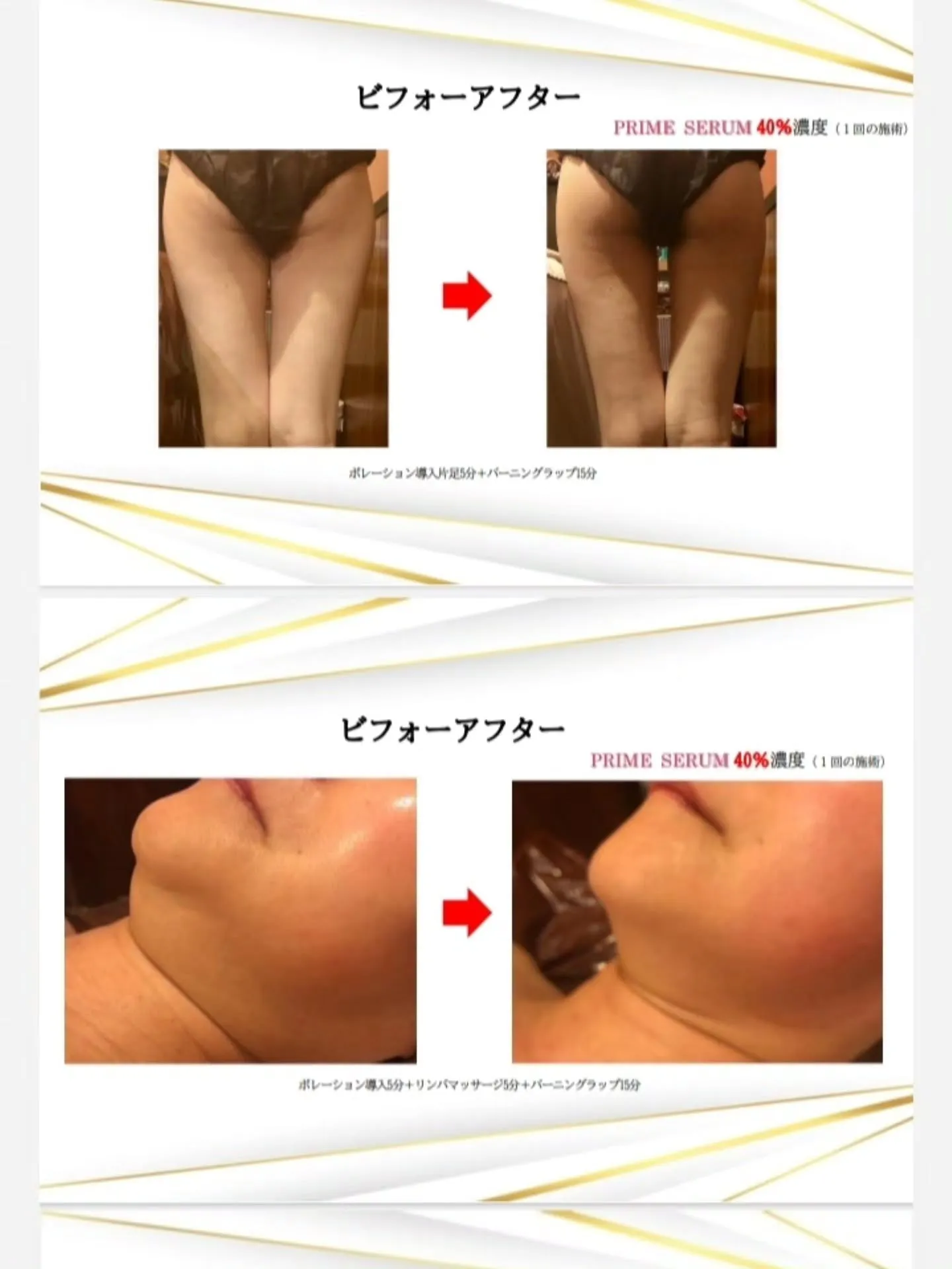 鹿児島市天文館で脂肪溶解剤と脂肪冷却を