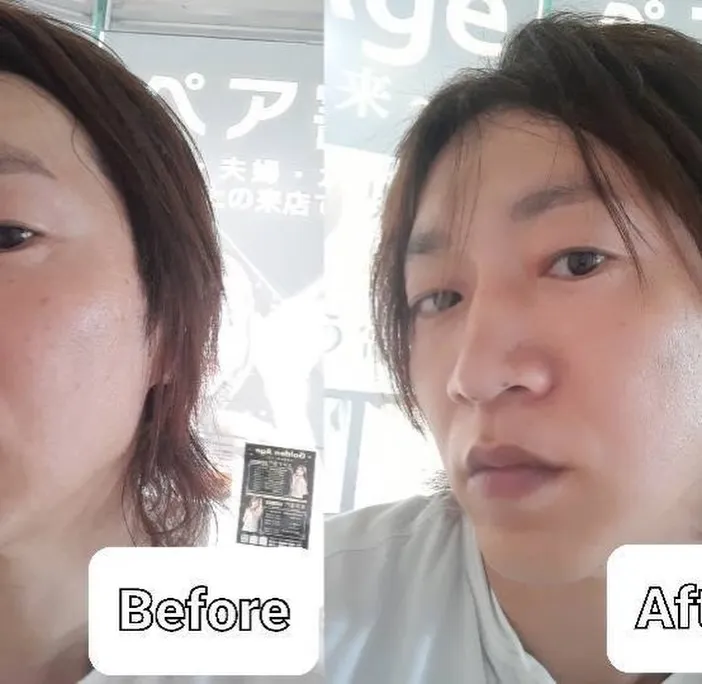 鹿児島市 天文館で痩身＋ほうれい線・しわ・たるみ解消を同時に...