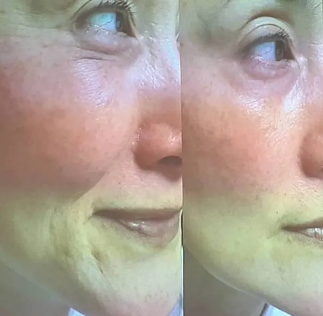 鹿児島市 天文館で痩身＋ほうれい線・しわ・たるみ解消を同時に...