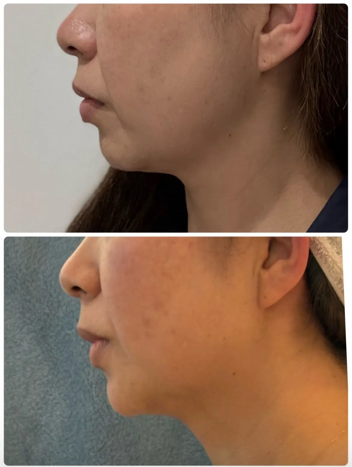 鹿児島市天文館で脂肪冷却やハーブピーリングがお得に受けられる...