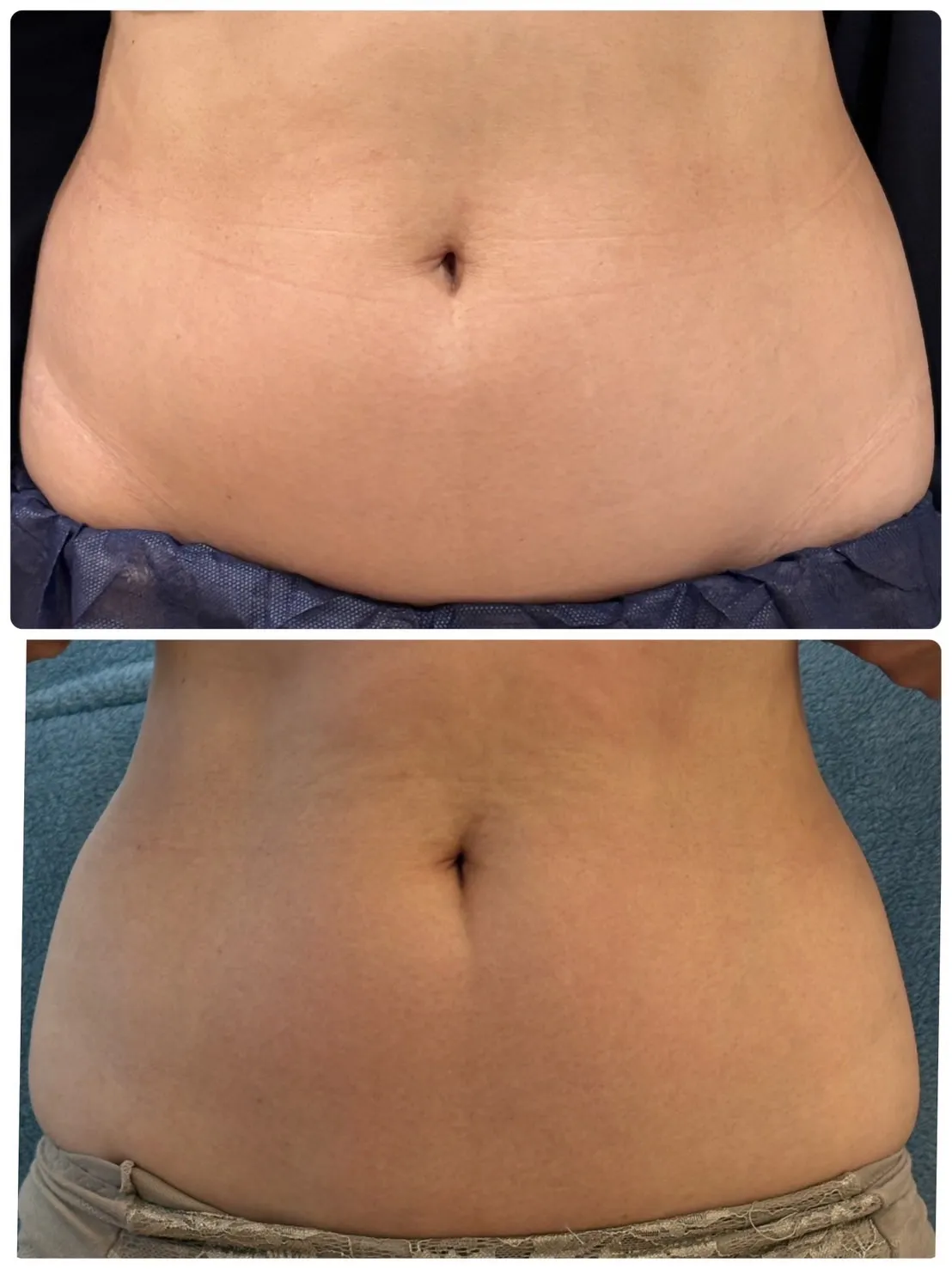 鹿児島市天文館で脂肪冷却やハーブピーリングがお得に受けられる...