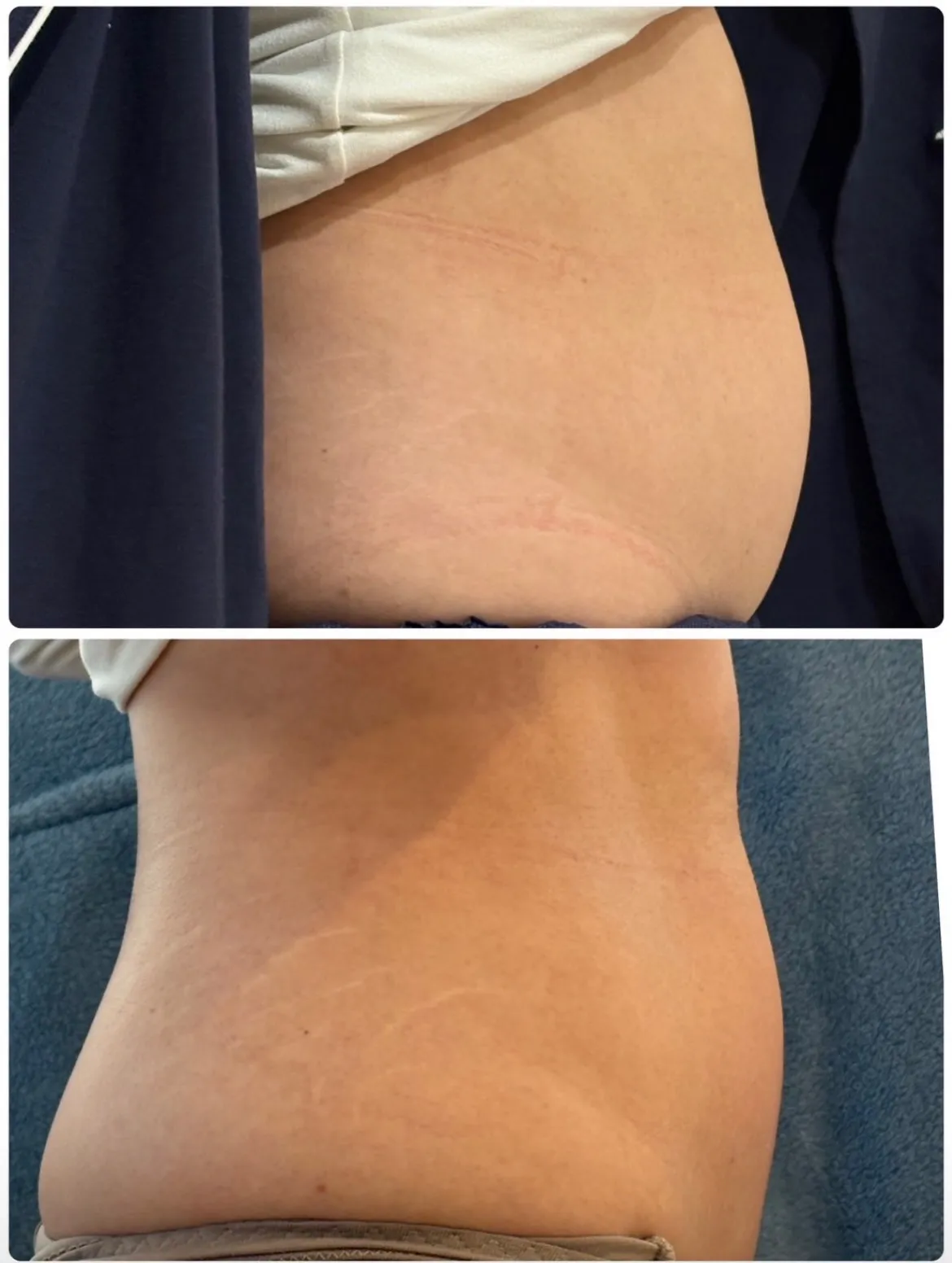 鹿児島市天文館で脂肪冷却やハーブピーリングがお得に受けられる...