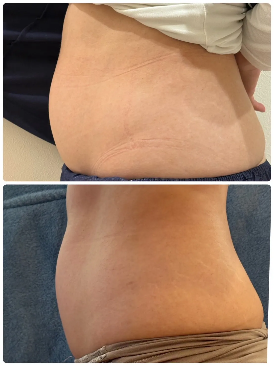 鹿児島市天文館で脂肪冷却やハーブピーリングがお得に受けられる...