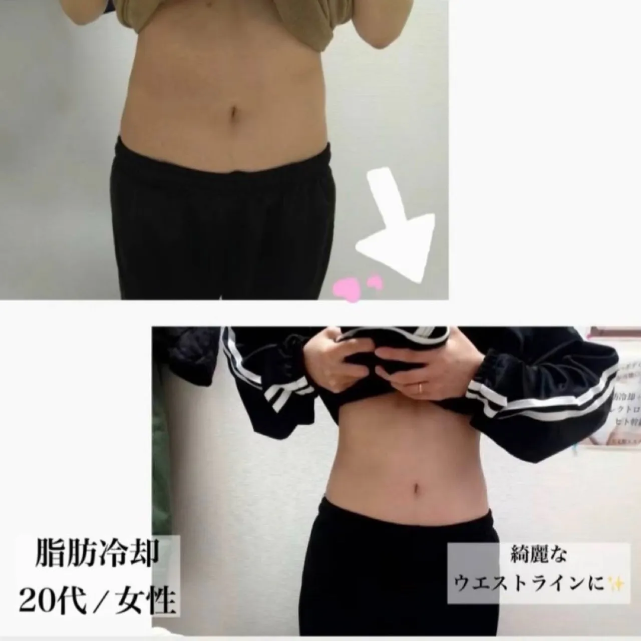 鹿児島市天文館で脂肪冷却をくびれが作れる？😆